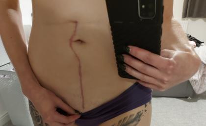 A photo of Lucy's scar after surgery to remove the 20cm tumour